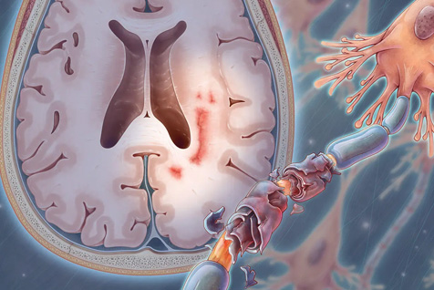 Multiple Sclerosis Treatment in Marine Lines