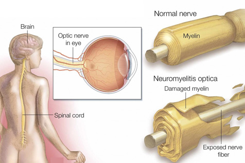 Neuromyelitis Optica Specialist In Marine Lines